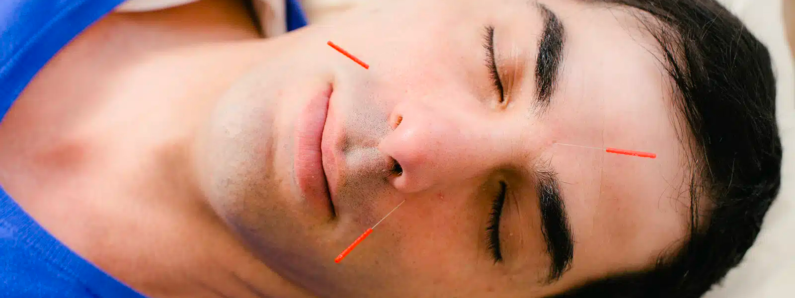 What Is Cosmetic Acupuncture?